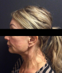Ultherapy Case 2 After